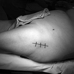 Incision marks hip surgery
