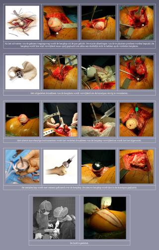 The resurfacing hip prosthesis